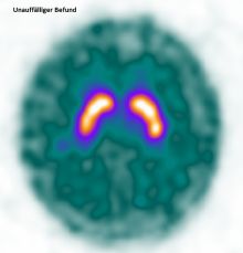 DAT-Scan (Unauffälliger Befund)