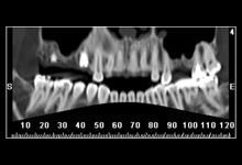 Dental CT