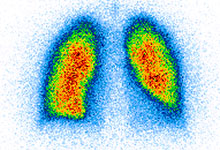 Scintigraphie pulmonaire